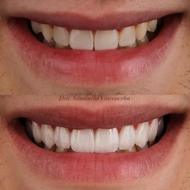 Antes & Depois